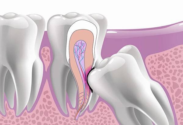 Зуб мудрости растет в щеку: симптомы, фото и что делать