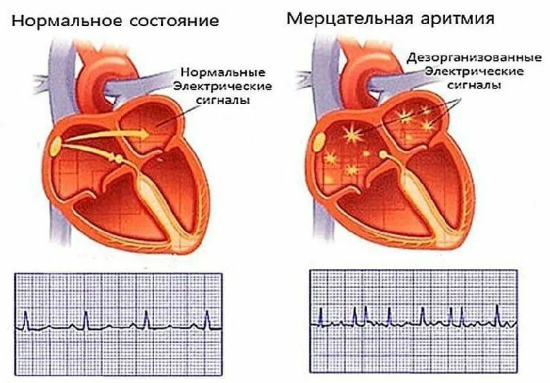 Нарушение ритма сердца карта вызова