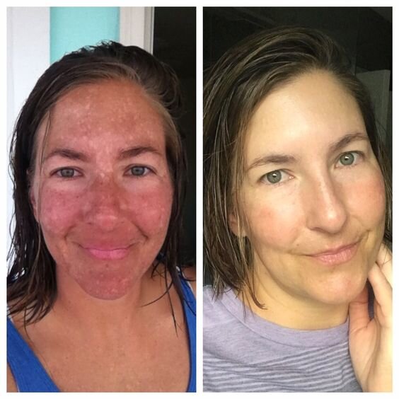 "Маска беременности" @rejuvenatewithjenn