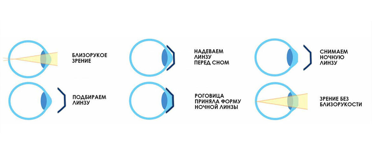 Почему в линзах двоится изображение