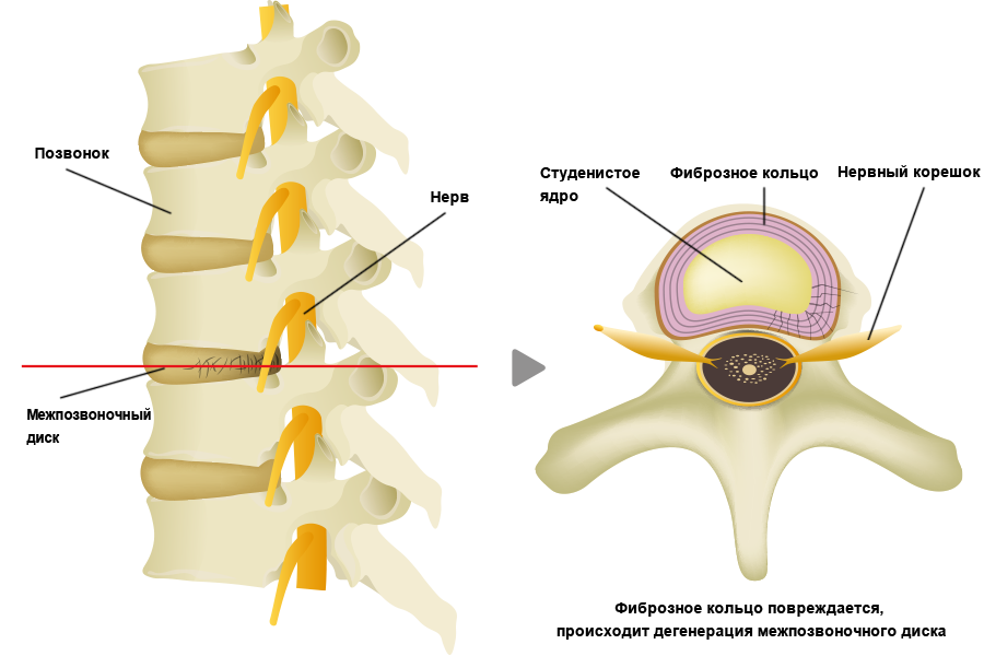 Название грыжи позвоночника. Студенистое ядро межпозвоночного диска. Межпозвонковый диск студенистое ядро. Фиброзное кольцо и студенистое ядро. Фиброзное кольцо межпозвоночного диска студенистое.