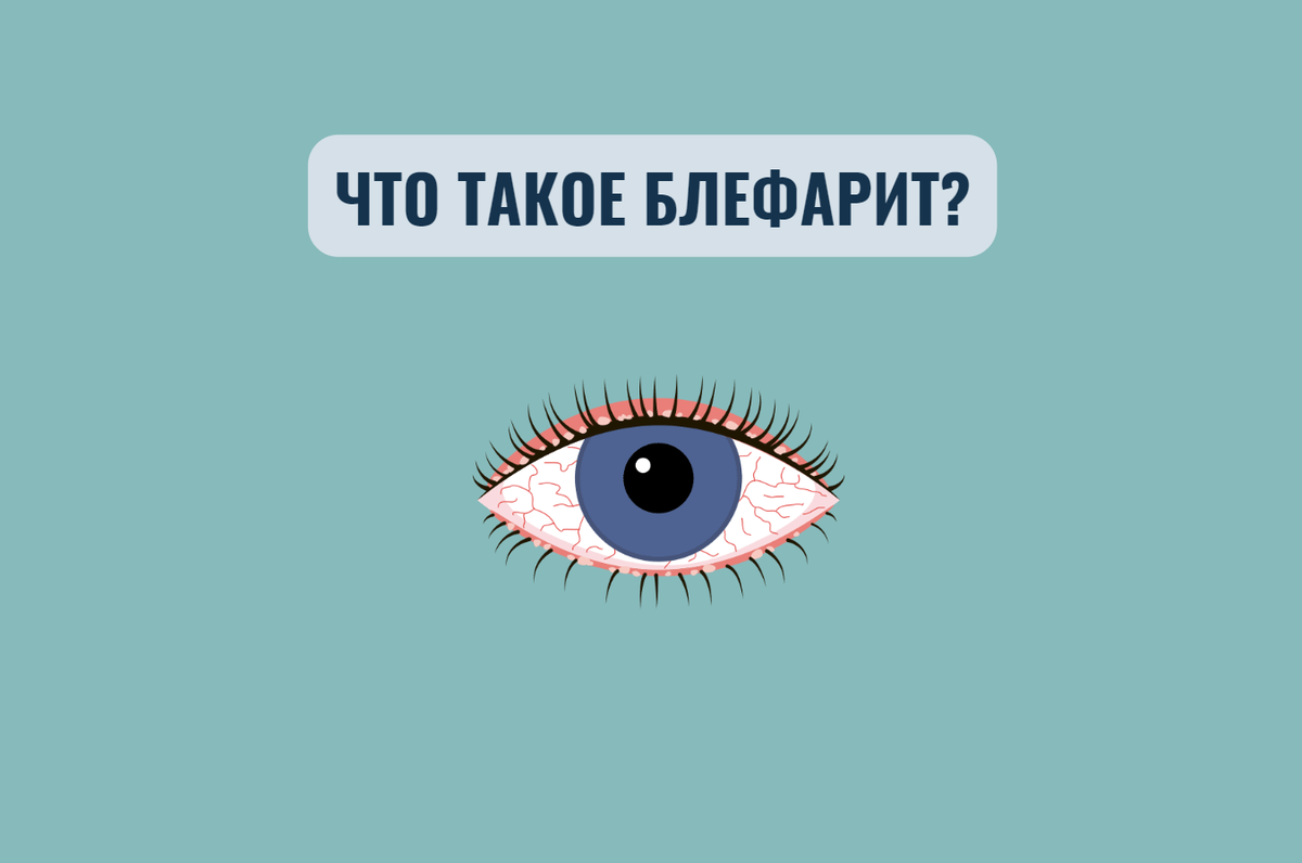 Блефарит: симптомы и лечение воспаления века - Medside.ru