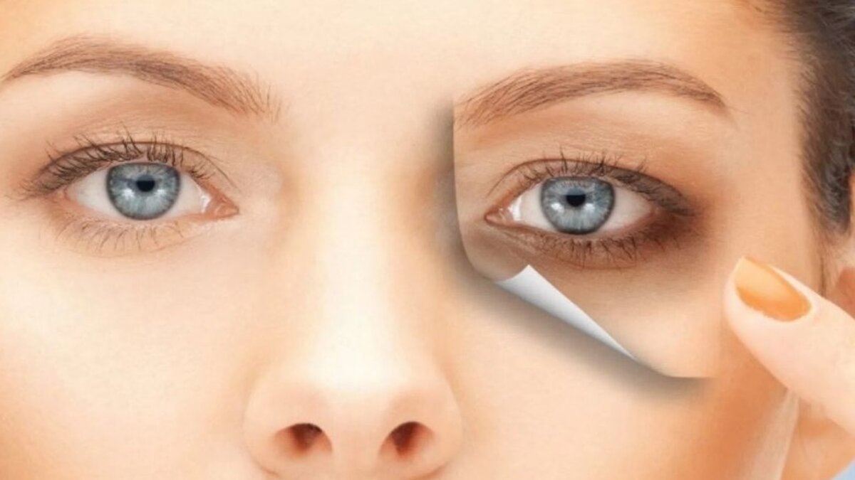 Как избавиться от темных кругов