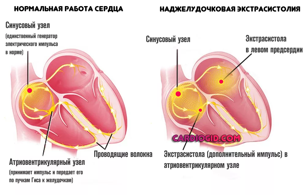 При суправентрикулярной экстрасистолии сердце или отдельные его участки сокращаются вне очереди