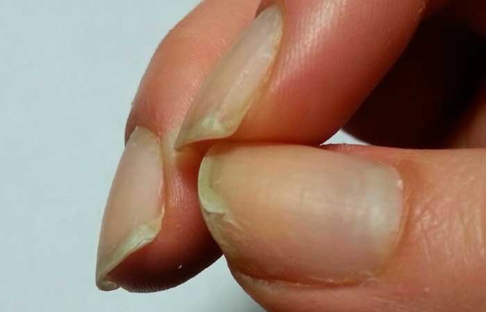 Ломкие и слоящиеся ногти.