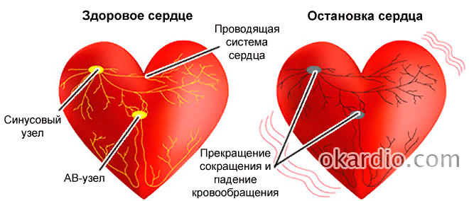 Как будто сердце останавливается. Причины остановки сердца. Кардиальные причины остановки сердца. Сердце остановилось.