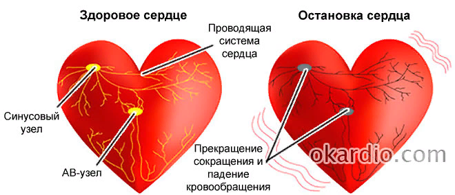 Внезапно останавливается сердце. Причины остановки сердца. Кардиальные причины остановки сердца. Сердце остановилось.