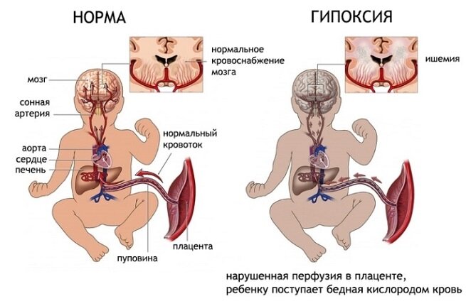 [caption id="attachment_1600" align="aligncenter" width="655"] Гипоксия плода - одна из причин ППЦНС[/caption]