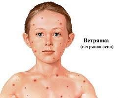 Типичная сыпь у ребенка с ветрянкой