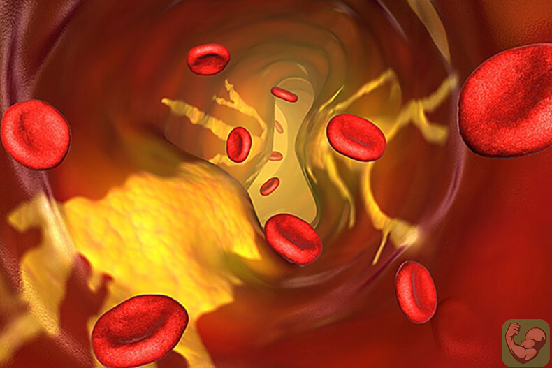 Избыток "плохого" холестерина.