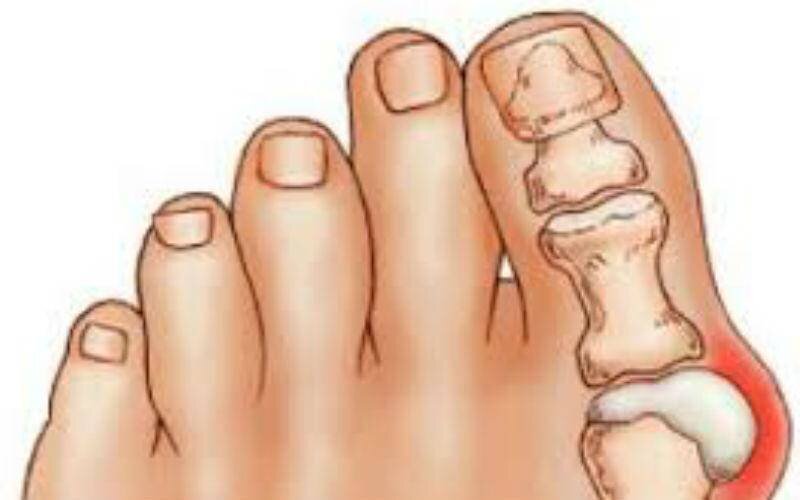 Вальгусная деформация стопы