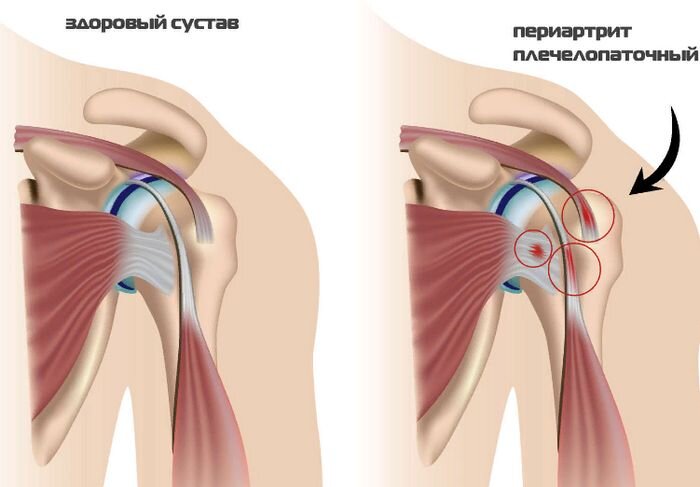 Плечелопаточный периартроз – статьи о здоровье