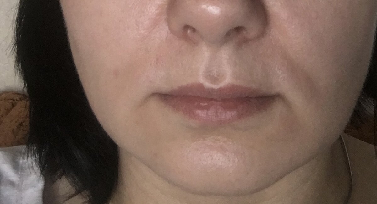 Мои губы до процедуры.