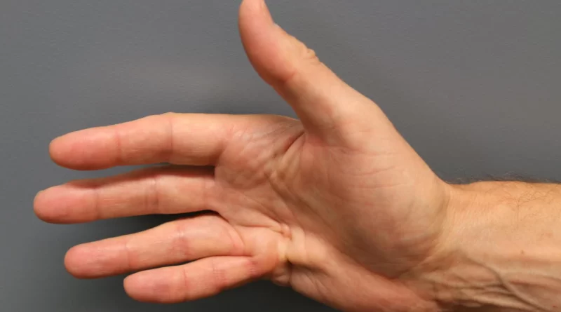 Контрактура Дюпюитрена во всей красе. Стадия 2, как мне думается. Об этом - ниже