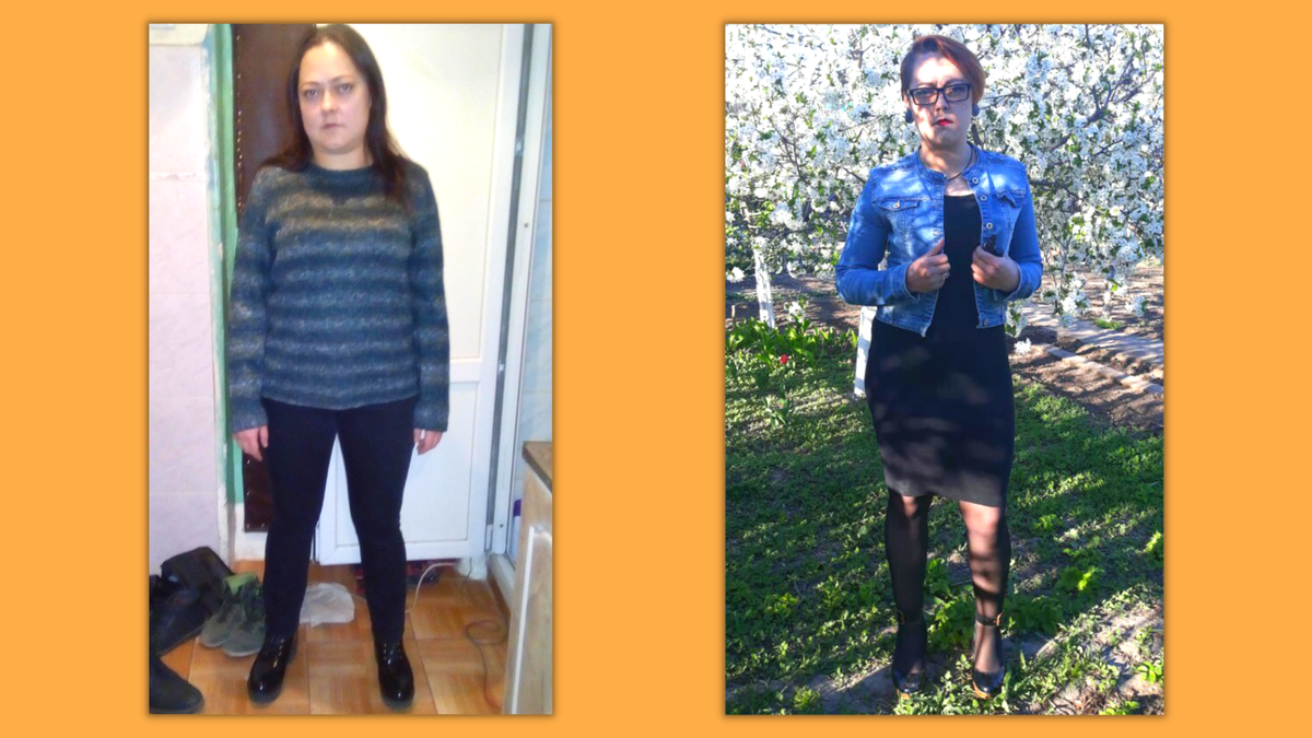 Мои ДО и ПОСЛЕ: похудела на 25 кг до операции по удалению щитовидной железы