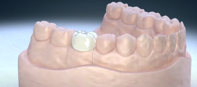 Анимация – зубная коронка для нижнего моляра на модели челюсти