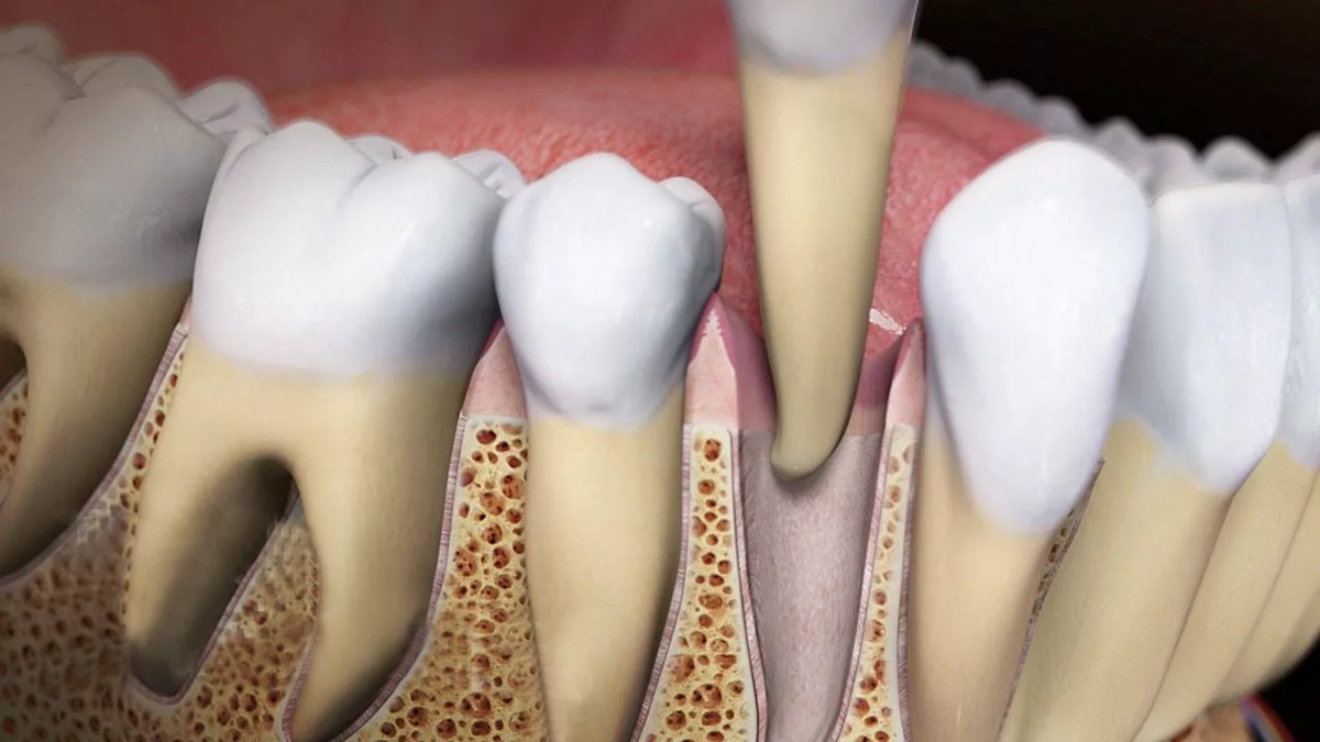 Extracted teeth. Как удаляют коренной зуб. Операция по зубу коренному.