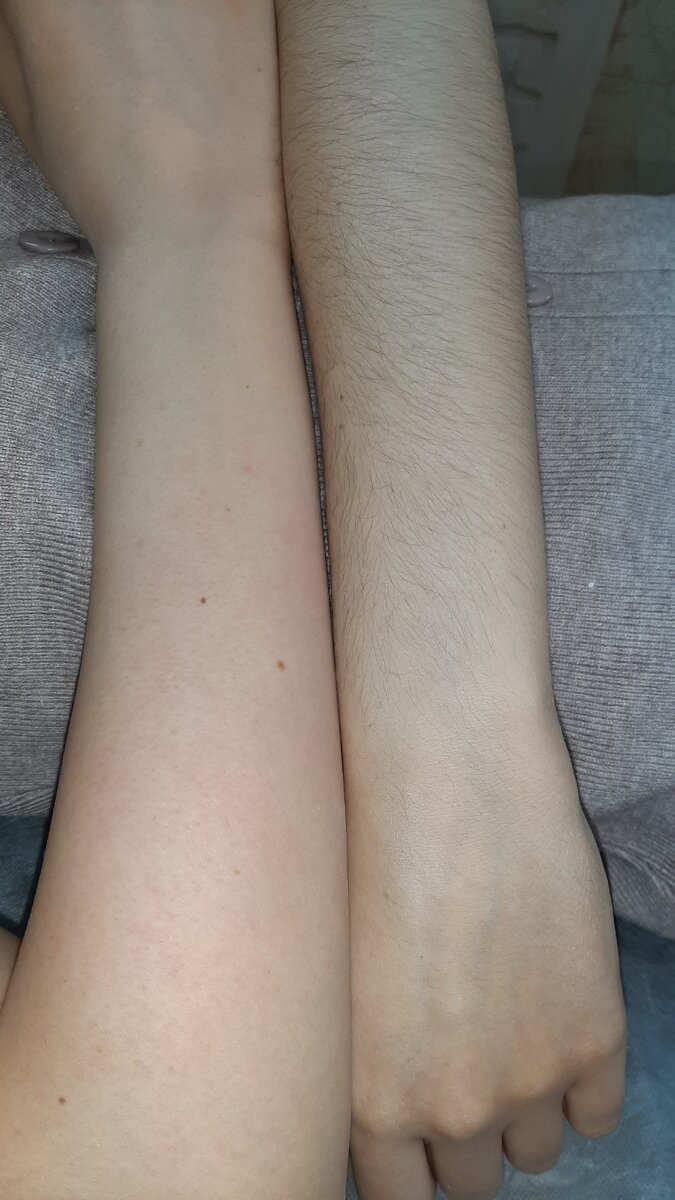 ручки в процессе процедуры шугаринга, обратите внимание на кожу отработанной руки, нет даже стандартного покраснения. фото без фильтров.