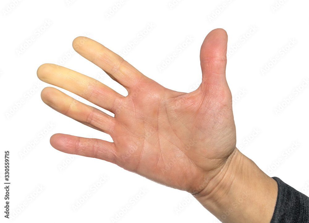 Варианты поражения кожи при системной склеродермии, кожа пальцев плотная, светлая, может снижаться чувствительность. Листай дальше -->