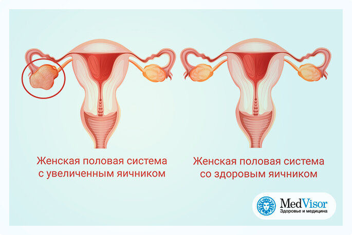 Острые и хронические заболевания яичников - оофорит