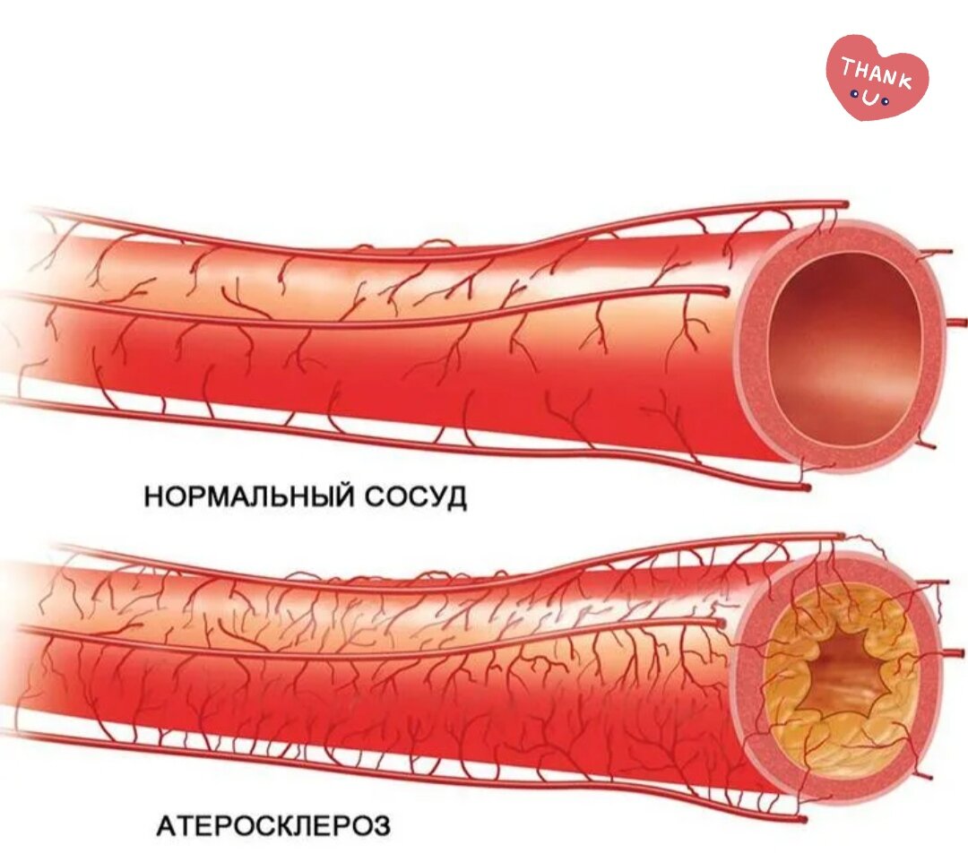 Восстановить сосуды после. Атеросклеротическое поражение коронарных сосудов. Атеросклероз аорты и коронарных артерий. Атеросклероз коронарных артерий сосуды. Атеросклеротическая бляшка коронарного сосуда.