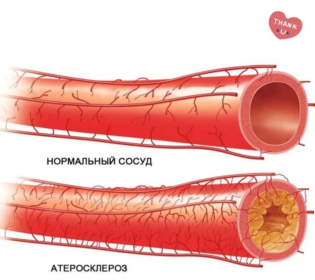 Плохие сосуды. Атеросклероз аорты и коронарных артерий. Атеросклеротическое поражение коронарных сосудов. Атеросклероз венечных артерий. Коронарные сосуды с атеросклеротическими бляшками.