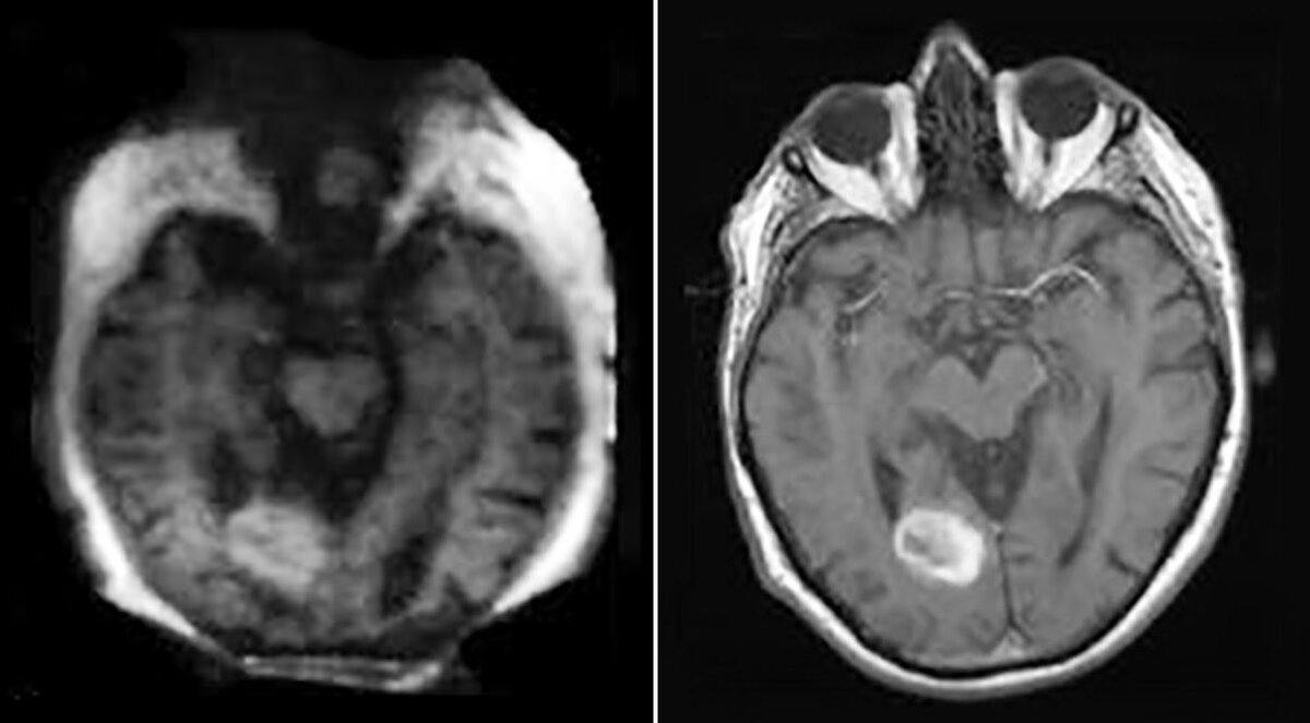 Разрешение сканирования мозга с помощью низкопольного аппарата (первое изображение) более грубое, чем у обычной МРТ (второе изображение), но на обоих изображениях четко видно кровоизлияние. 