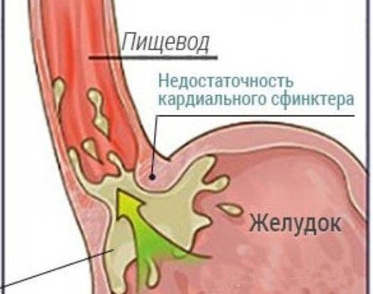 недостаточность кардии (кардиальный или нижний пищеводный сфинктер).