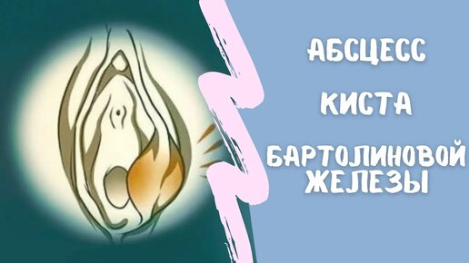 АБСЦЕСС и КИСТА БАРТОЛИНОВОЙ железы. ПРИЧИНЫ. Основные принципы ЛЕЧЕНИЯ. Бартолинит.