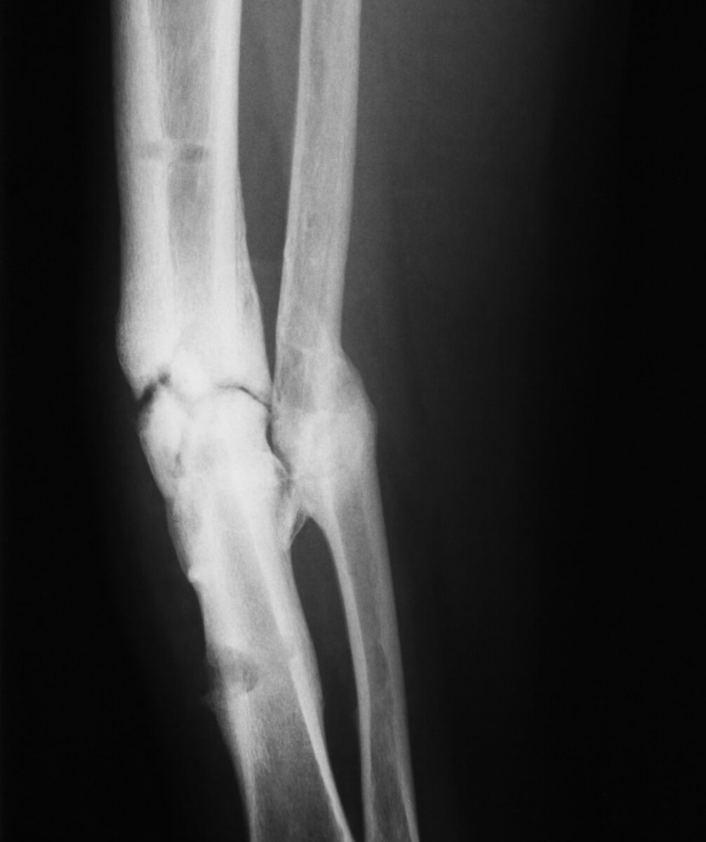 Перелом большеберцовой кости диафиза | EMC