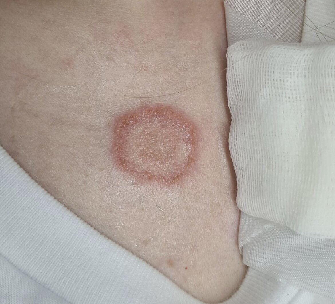 Микроспория. Фото из личного архива врача-дерматолога Тимачевой И.А.