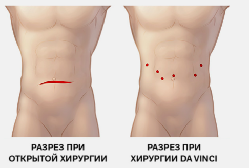 Разрез при роботической хирургии представляет из себя небольшой прокол брюшной стенки