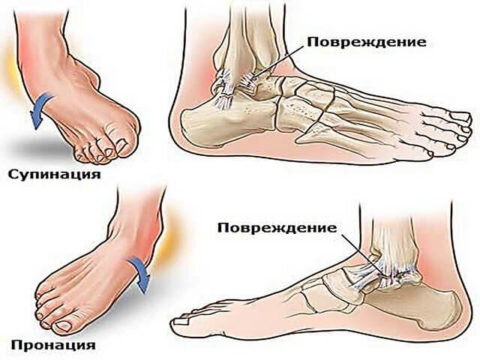  Повреждение  лодыжек