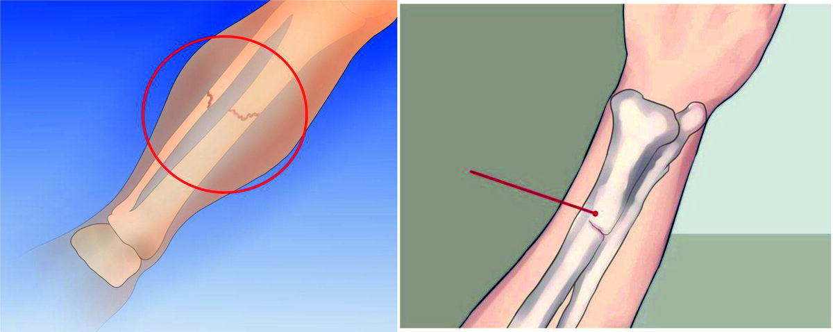 Лечение трещины кости