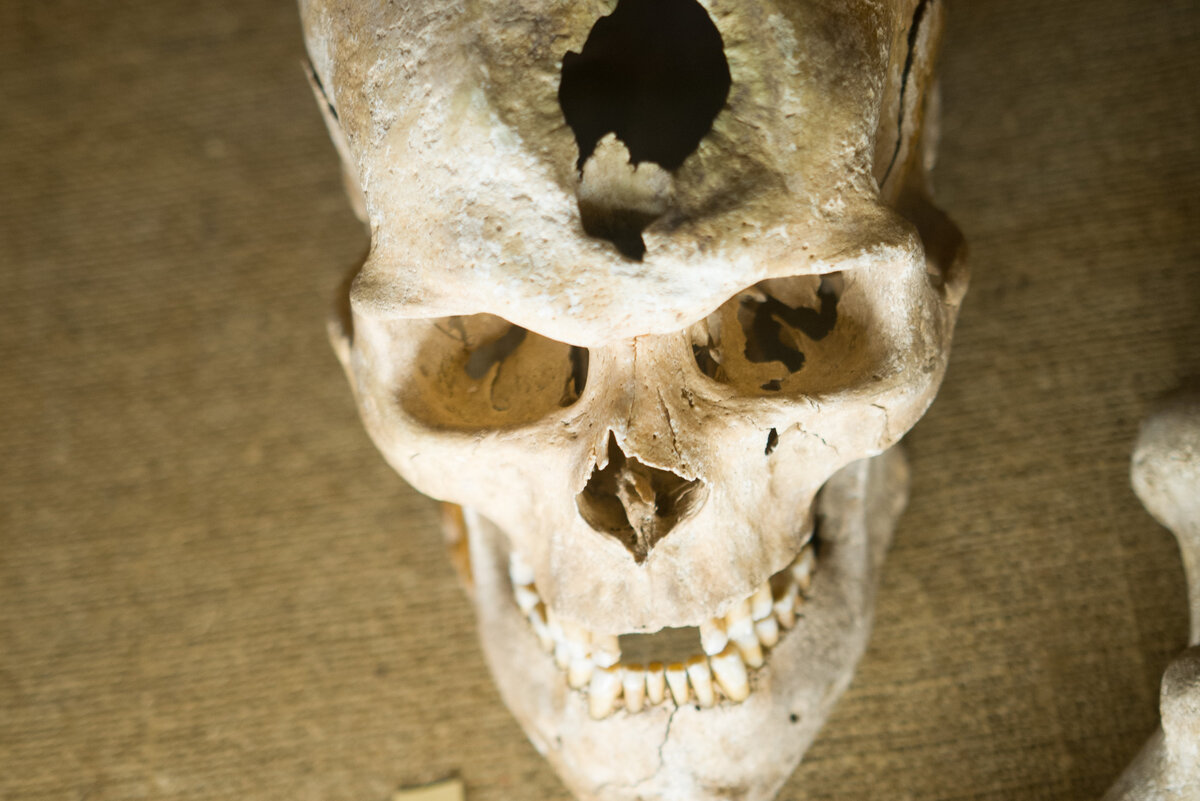 Дырявый череп - экспонат Музея медицины, Каунас