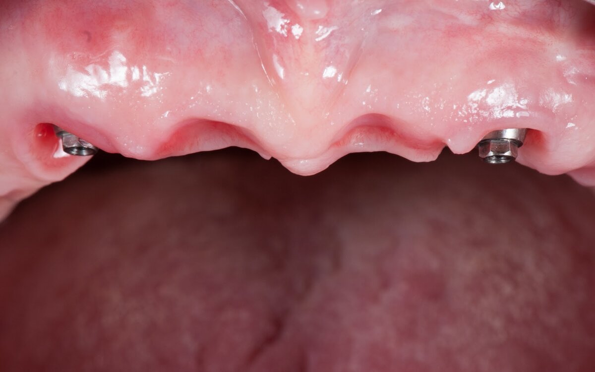 Сформированный временными протезами рельеф слизистой оболочки, который позволяет сделать эстетическое протезирование в переднем отделе даже при полном отсутствии зубов. 