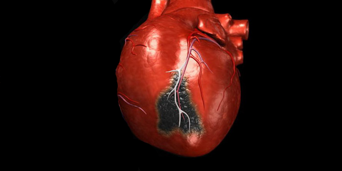 Нередко инфаркт возникает внезапно и его течение не всегда отличается классическими симптомами, но требует немедленной помощи, вплоть до реанимации.