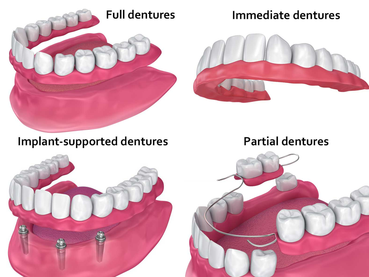 Cкринщшот-цитата - разновидности dentutres https://d3b3by4navws1f.cloudfront.net/AllDentures.jpg