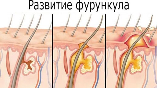 Как быстро вылечить фурункул и карбункул в домашних условиях | Солнышко