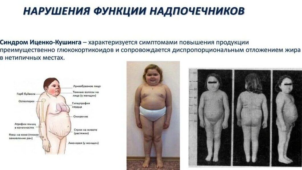 Серьёзнейшее нарушение функции надпочечников. Я заболела им в 18 лет... Но даже в таких случаях не стоит отчаиваться. Наладить работу надпочечников можно. Читайте 👇