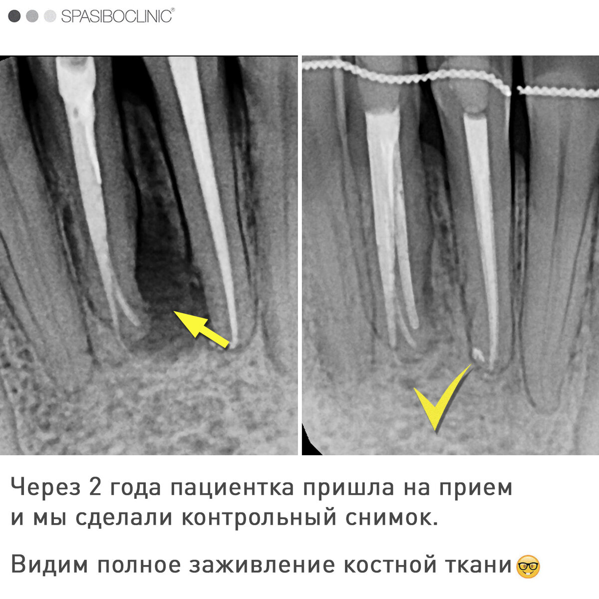 Почему возникают гемангиомы позвоночника?