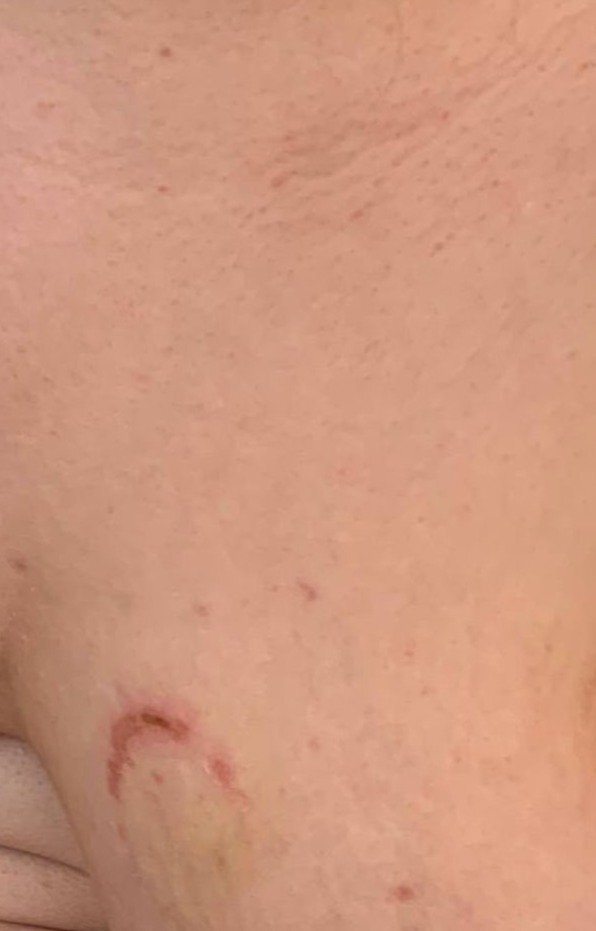 Укус на теле подростка. Фото: Telegram-канал Никиты Сорокина