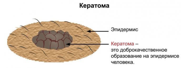 Лечение кератом