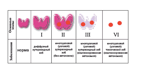 Коллоидный зоб: лечение и диагностика причин, симптомов в Москве