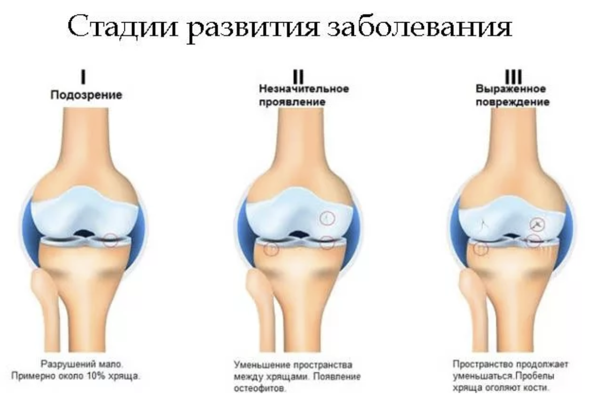 Остеоартроз это. Деформирующий остеоартроз коленного сустава 1. Деформирующий остеоартроз коленного сустава степени. Деформирующий остеоартроз 1 стадия. Стадии деформирующего остеоартроза коленных суставов.