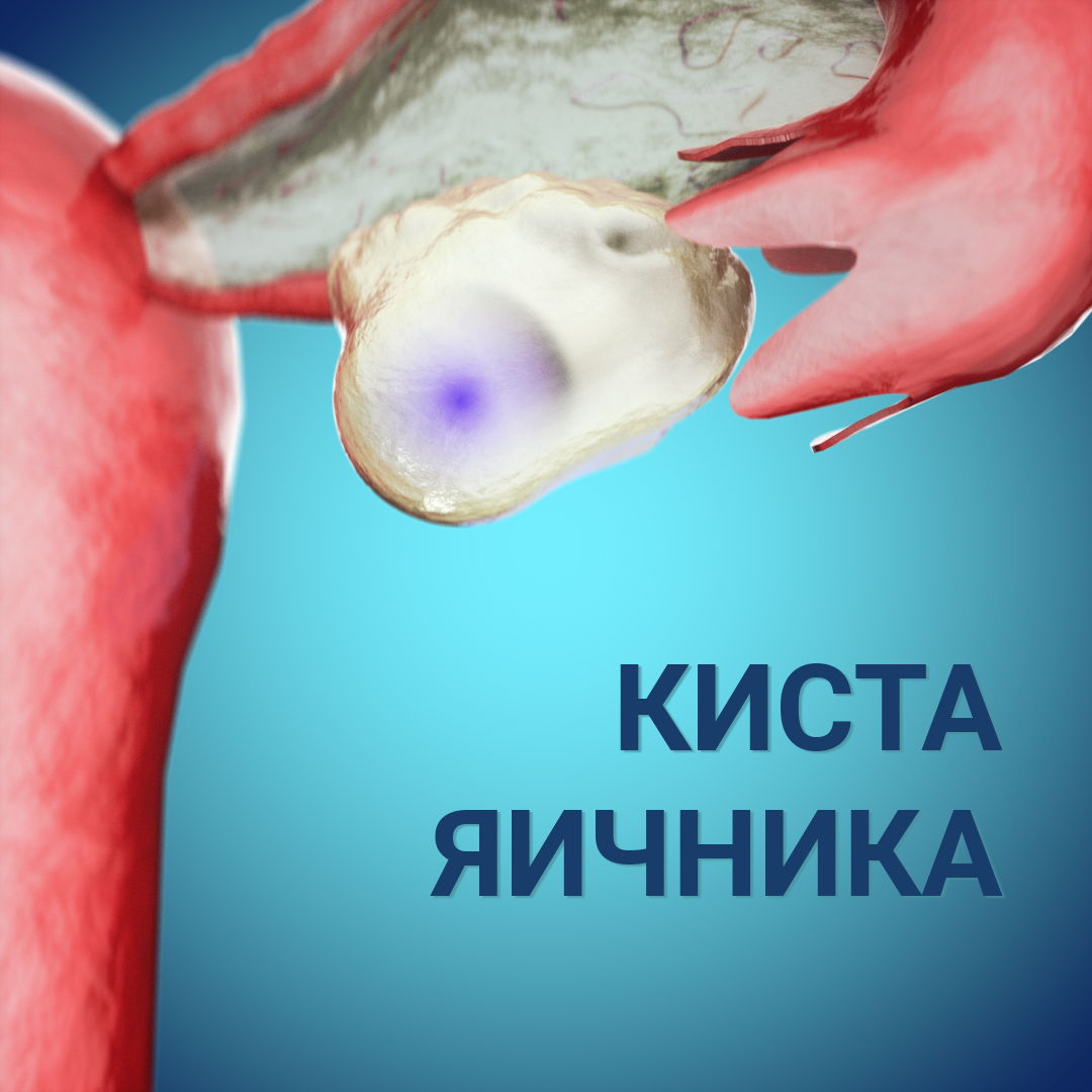 Примерно такой вид имеет киста яичника