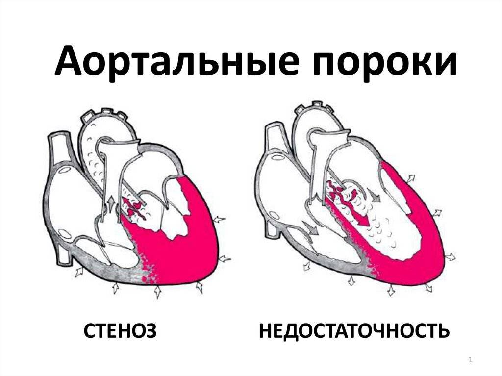 Данное изображение хорошо иллюстрирует изменение левого желудочка при патологиях аортального клапана. Ссылка: https://vseglisty.ru/simptomy/poperecnik-serdca-v-norme-cto-eto-takoe-u-detej-cemu-raven-pri-nedostatocnosti-aortalnogo-klapana-gipertrofii-zeludocka-mitralnom-stenoze.html