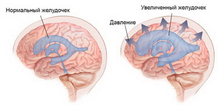 Увеличенные желудочки. Гидроцефалия желудочков головного мозга. Гидроцефалия четвертого желудочка. Внутричерепное давление. Механизм развития гидроцефалии.