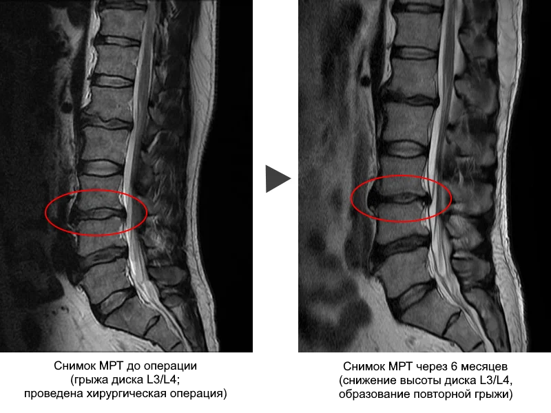 Удаления грыжи позвоночника поясничного отдела отзывы. Межпозвонковые диски дегидратированы что это. Трещина межпозвонкового диска. Уплотнение в межпозвонковом диске. Замена позвоночного диска.