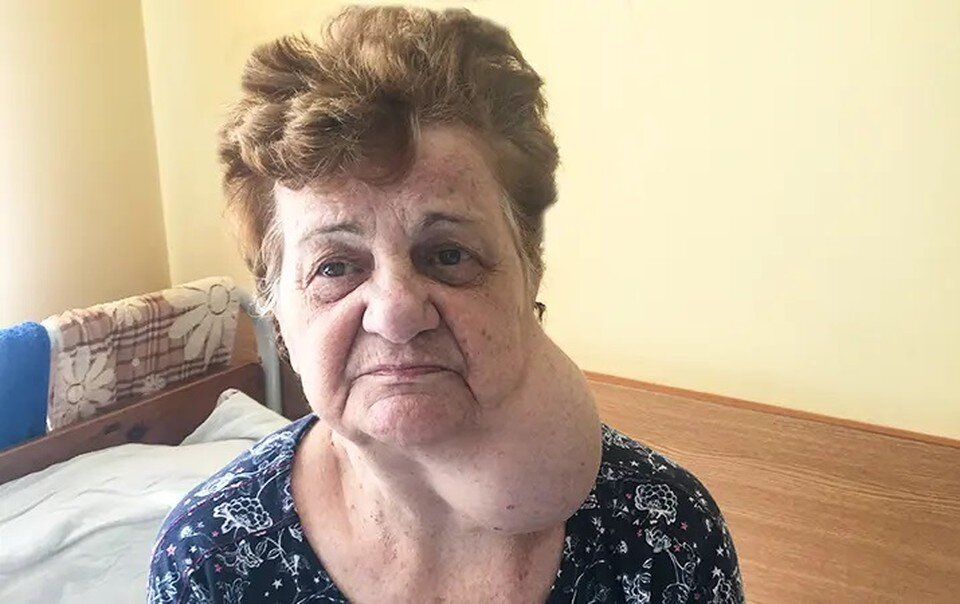     В Гродно хирурги удалили аневризму сонной артерии размером 12-13 см 75-летней женщине. Фото: завотделением сосудистой хирургии Гродненской университетской клиники Павла Горячева/ Медицинский вестник